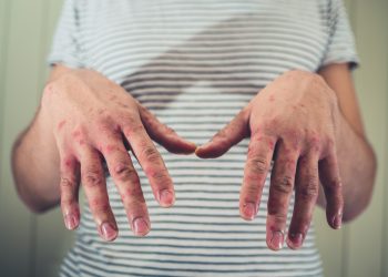 Colorado sees first measles case in four years after traveler tests positive
