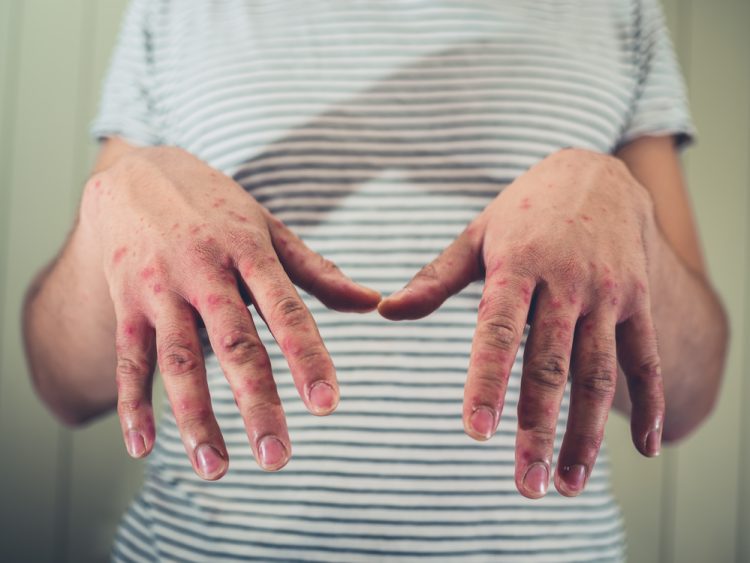 Colorado sees first measles case in four years after traveler tests positive