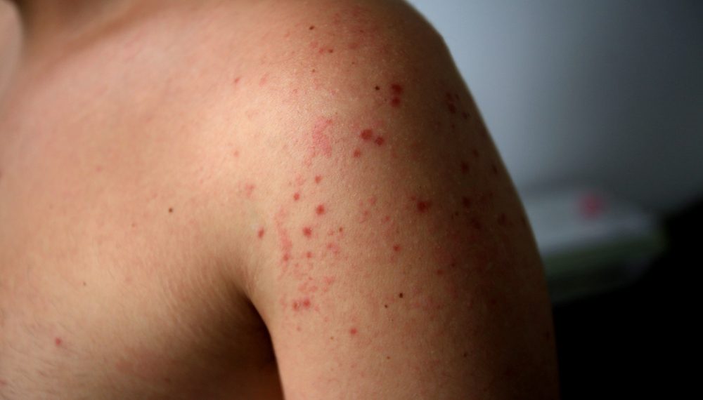 Third Measles Case Confirmed in Colorado; Possible Exposures in Pagosa Springs