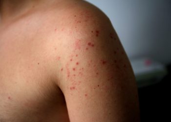 Third Measles Case Confirmed in Colorado; Possible Exposures in Pagosa Springs