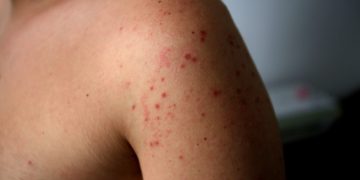 Third Measles Case Confirmed in Colorado; Possible Exposures in Pagosa Springs