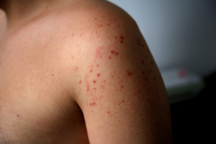 Third Measles Case Confirmed in Colorado; Possible Exposures in Pagosa Springs