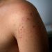 Third Measles Case Confirmed in Colorado; Possible Exposures in Pagosa Springs